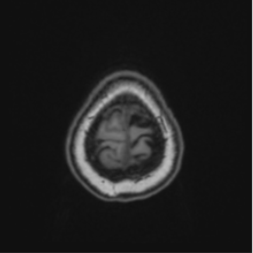 Cerebral abscess from pulmonary arteriovenous malformation (Radiopaedia 86275-102291 Axial T1 70).png