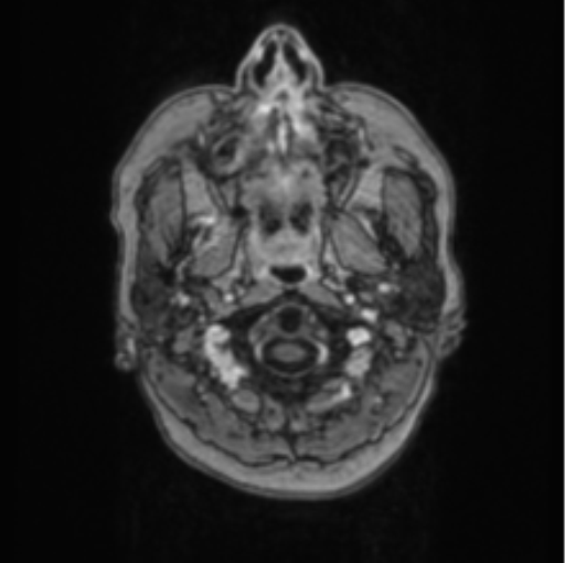 Cerebral abscess from pulmonary arteriovenous malformation (Radiopaedia 86275-102291 Axial T1 C+ 2).png