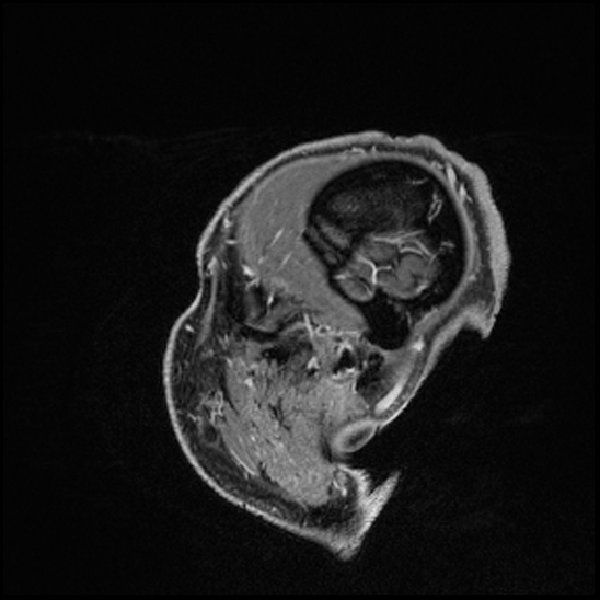 Cerebral abscess with ventriculitis (Radiopaedia 78965-91878 Sagittal T1 C+ 166).jpg