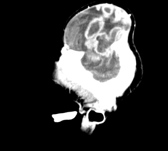 Cerebral abscesses (Radiopaedia 70458-80568 Sagittal Contrast 8).jpg