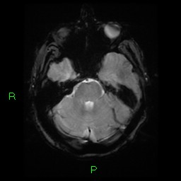 File:Cerebral amyloid angiopathy-associated lobar intracerebral hemorrhage (Radiopaedia 58376-65512 Axial Gradient Echo 19).jpg