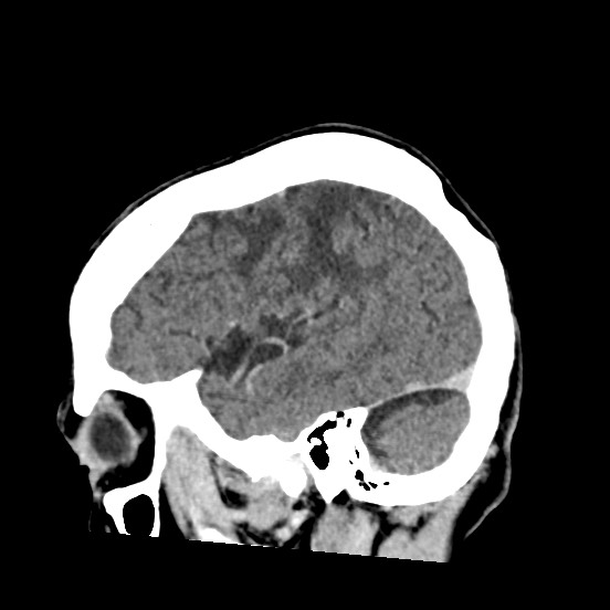 Cerebral amyloid angiopathy-related inflammation (Radiopaedia 74836-85848 C 14).jpg