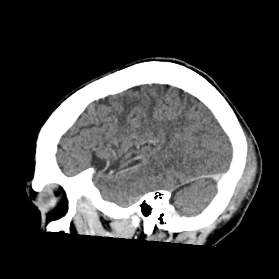Cerebral amyloid angiopathy-related inflammation (Radiopaedia 74836-85848 C 47).jpg