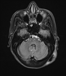 File:Cerebral amyloid angiopathy-related inflammation (Radiopaedia 74836-85849 Axial FLAIR 8).jpg