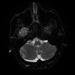 File:Cerebral amyloid angiopathy (Radiopaedia 28698-28978 Axial DWI 33).jpg