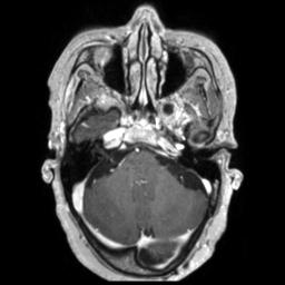 Cerebral amyloid angiopathy (Radiopaedia 29129-29518 Axial T1 C+ 39).jpg