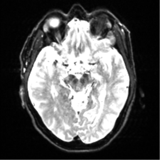 File:Cerebral amyloid angiopathy (Radiopaedia 46082-50433 Axial DWI 11).png