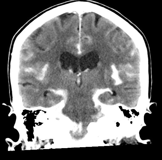 File:Cerebral aneurysm with rupture (Radiopaedia 29933-30460 Coronal non-contrast 21).jpg