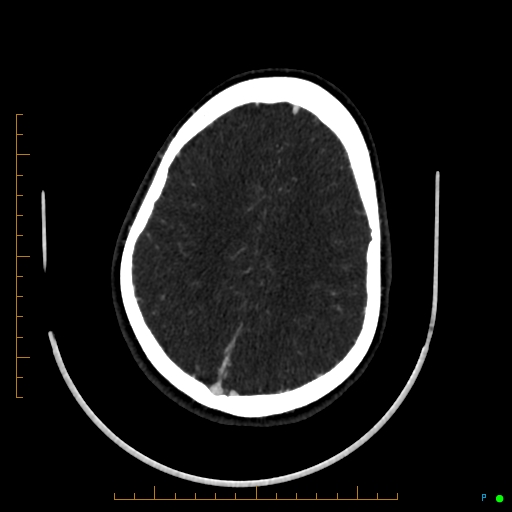 Cerebral arteriovenous malformation (AVM) (Radiopaedia 78162-90706 Axial CTA 205).jpg