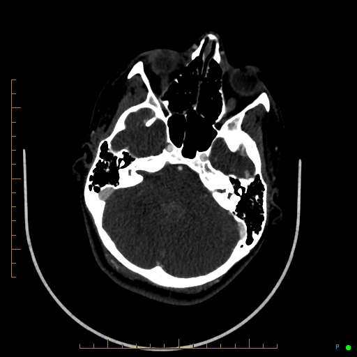 Cerebral arteriovenous malformation (AVM) (Radiopaedia 78162-90706 Axial CTA 83).jpg