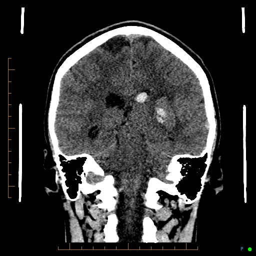 Cerebral arteriovenous malformation (AVM) (Radiopaedia 78162-90706 Coronal non-contrast 61).jpg