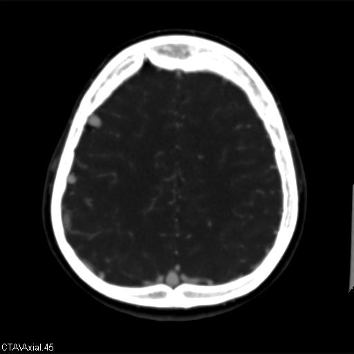 Cerebral arteriovenous malformation (Radiopaedia 28518-28759 B 45).jpg