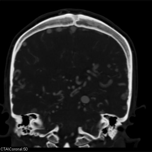 Cerebral arteriovenous malformation (Radiopaedia 28518-28759 C 50).jpg