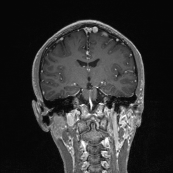 Cerebral arteriovenous malformation (Radiopaedia 30198-30813 F 32).jpg