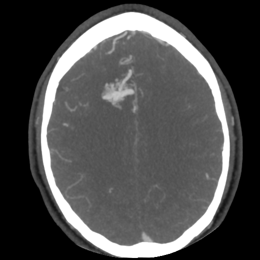Cerebral arteriovenous malformation (Radiopaedia 39259-41505 AX CEREBRAL CTA 38).png