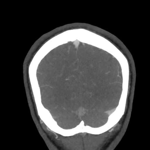 Cerebral arteriovenous malformation (Radiopaedia 39259-41505 E 60).png