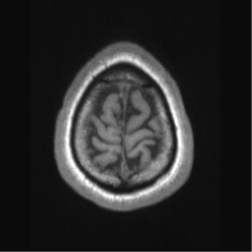Cerebral arteriovenous malformation (Radiopaedia 39259-41506 Axial T1 71).png