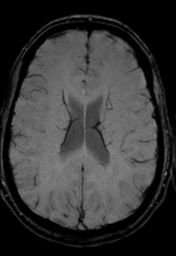 File:Cerebral arteriovenous malformation (Radiopaedia 55798-62372 Axial SWI 25).png