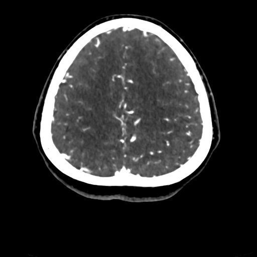 Cerebral arteriovenous malformation (Radiopaedia 73830-84645 Axial C+ delayed 19).jpg