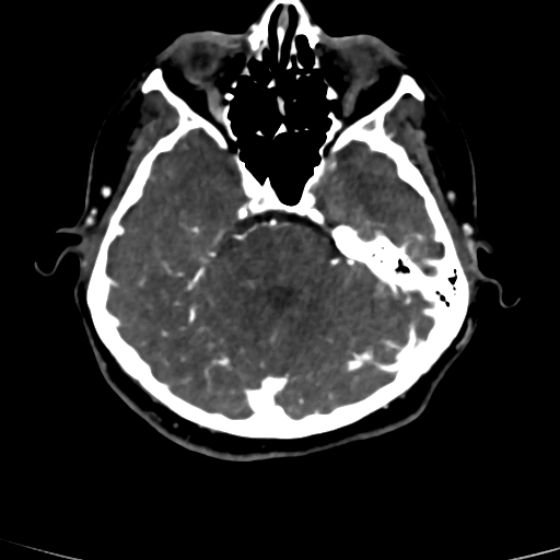 Cerebral arteriovenous malformation (Radiopaedia 73830-84645 Axial C+ delayed 66).jpg
