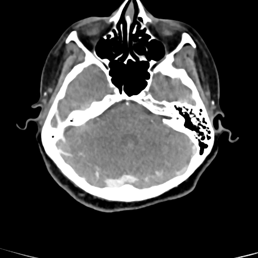 Cerebral arteriovenous malformation (Radiopaedia 73830-84645 B 73).jpg