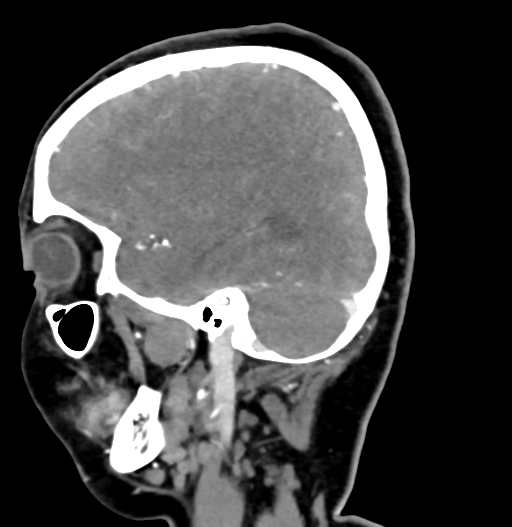 Cerebral arteriovenous malformation (Radiopaedia 73830-84645 D 26).jpg