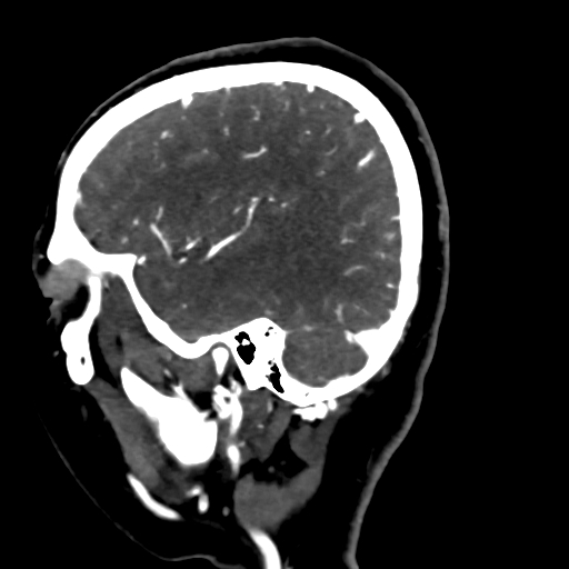 Cerebral arteriovenous malformation (Radiopaedia 73830-84645 Sagittal C+ delayed 20).jpg