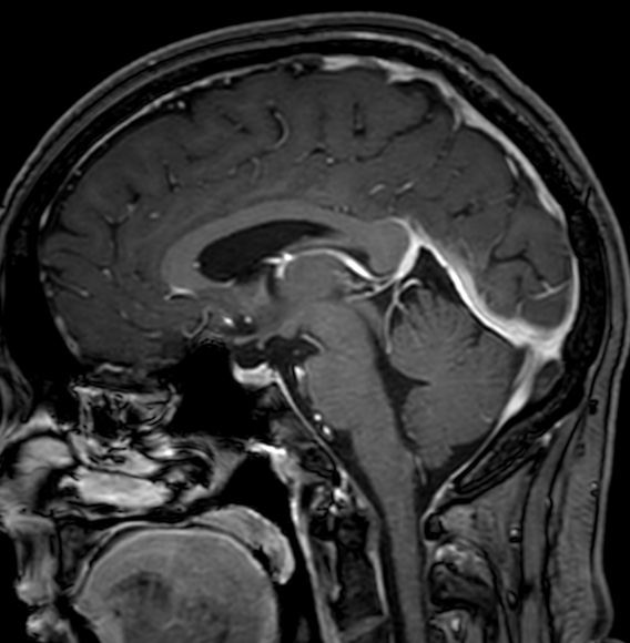 Cerebral arteriovenous malformation (Radiopaedia 74411-85746 Sagittal T1 C+ 63).jpg