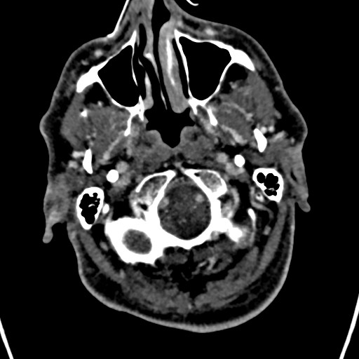 Cerebral arteriovenous malformation (Radiopaedia 78188-90746 Axial C+ delayed 14).jpg