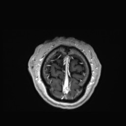 Cerebral arteriovenous malformation (Radiopaedia 84015-99245 Coronal T1 C+ 163).jpg