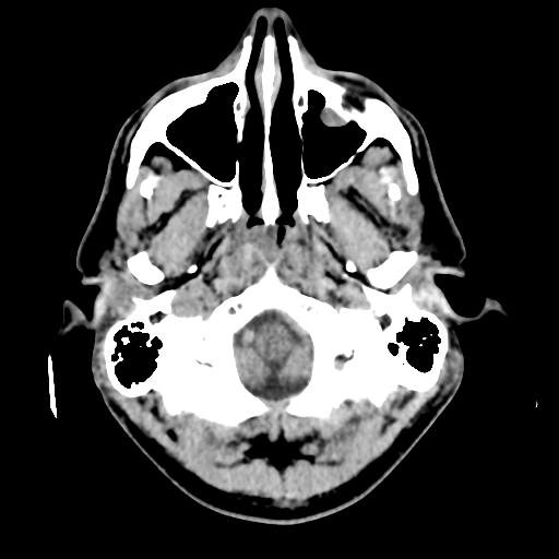 Cerebral arteriovenous malformation (Spetzler-Martin grade 2) (Radiopaedia 41262-44076 Axial non-contrast 8).png