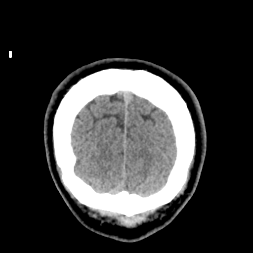 File:Cerebral arteriovenous malformation (Spetzler-Martin grade 2) (Radiopaedia 41262-44076 Coronal non-contrast 60).png