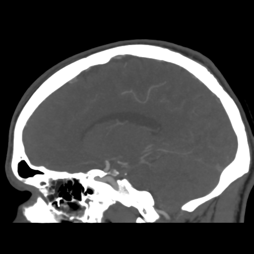 Cerebral arteriovenous malformation (Spetzler-Martin grade 2) (Radiopaedia 41262-44076 G 32).png