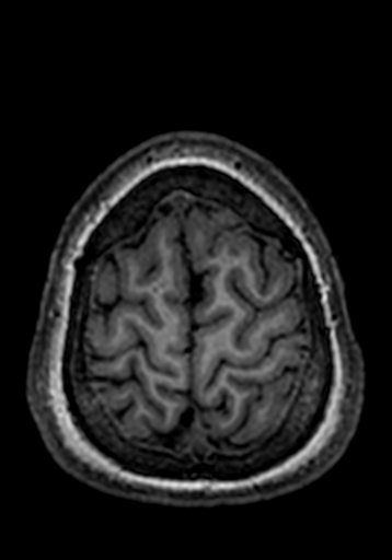 Cerebral arteriovenous malformation at posterior body of corpus callosum (Radiopaedia 74111-84925 Axial T1 22).jpg