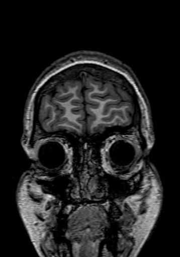 Cerebral arteriovenous malformation at posterior body of corpus callosum (Radiopaedia 74111-84925 Coronal T1 12).jpg