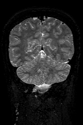 Cerebral arteriovenous malformation at posterior body of corpus callosum (Radiopaedia 74111-84925 Coronal T2 135).jpg