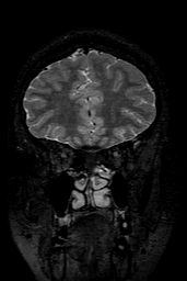 Cerebral arteriovenous malformation at posterior body of corpus callosum (Radiopaedia 74111-84925 Coronal T2 40).jpg