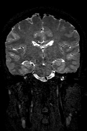 Cerebral arteriovenous malformation at posterior body of corpus callosum (Radiopaedia 74111-84925 Coronal T2 96).jpg