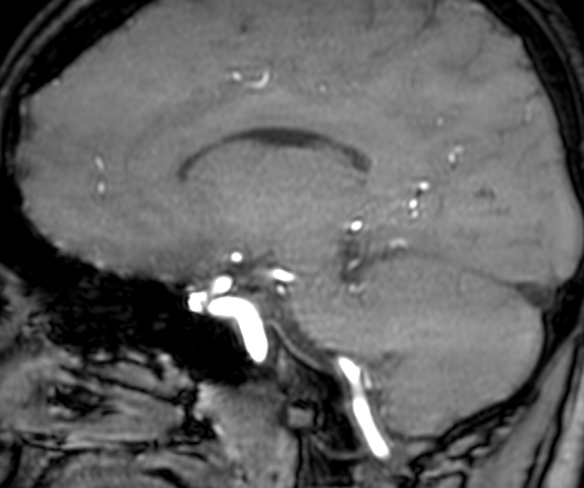 File:Cerebral arteriovenous malformation at posterior body of corpus callosum (Radiopaedia 74111-84925 J 230).jpg