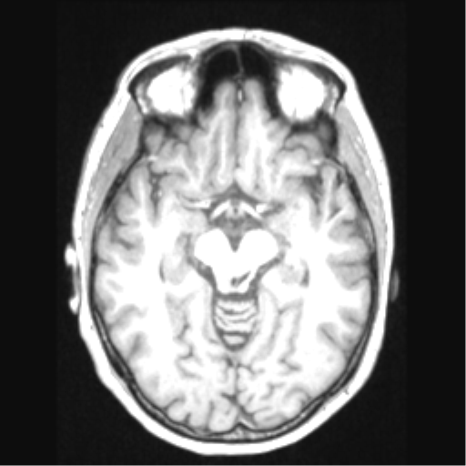 Cerebral arteriovenous malformation with hemorrhage (Radiopaedia 34422-35737 Axial T1 33).png