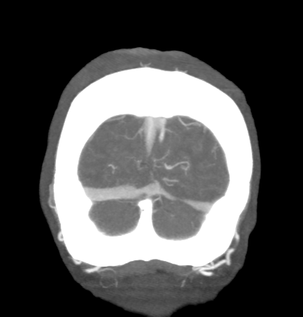 Cerebral arteriovenous malformation with lobar hemorrhage (Radiopaedia 44725-48511 B 52).png