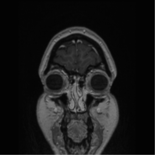 Cerebral cavernoma and development venous anomaly (Radiopaedia 37603-39482 Coronal T1 C+ 85).png