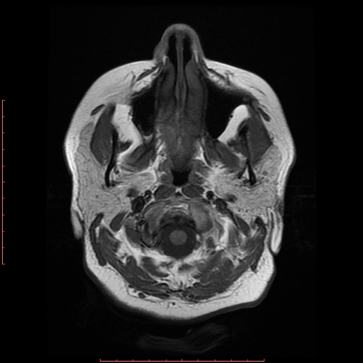 File:Cerebral cavernous malformation (Radiopaedia 26177-26306 Axial T1 2).jpg