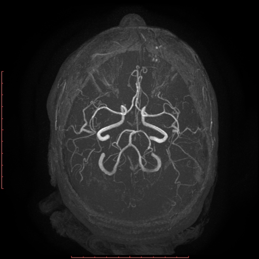 File:Cerebral cavernous malformation (Radiopaedia 26177-26306 MRA 1).jpg