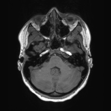 Cerebral cavernous venous malformation (Radiopaedia 70008-80021 Axial T1 15).jpg