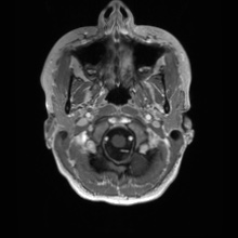 Cerebral cavernous venous malformation (Radiopaedia 70008-80021 Axial T1 C+ 2).jpg