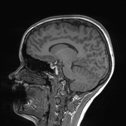 File:Cerebral cavernous venous malformation (Radiopaedia 70008-80021 Sagittal T1 43).jpg