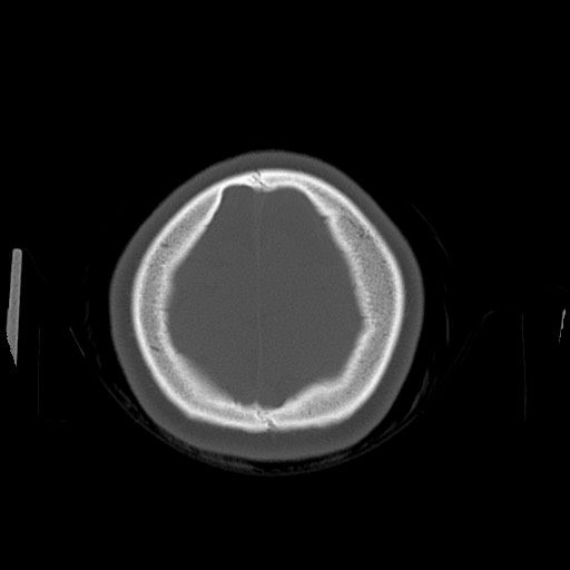 Cerebral cavernous venous malformation (Radiopaedia 70008-80022 Axial bone window 50).jpg