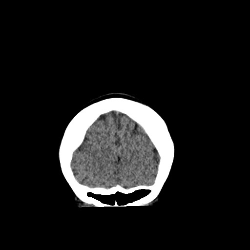 Cerebral cavernous venous malformation (Radiopaedia 70008-80022 non-contrast 7).jpg