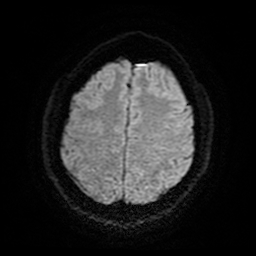 Cerebral cavernous venous malformation (Zabramski type II) (Radiopaedia 85511-101198 Axial DWI 24).jpg
